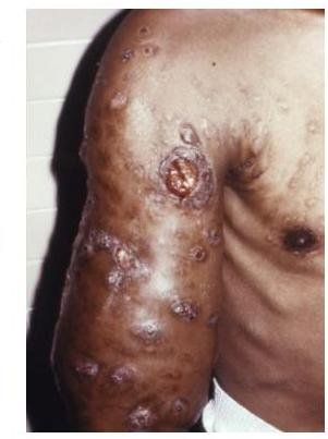 Imagen de abscesos cutáneos o subcutáneos