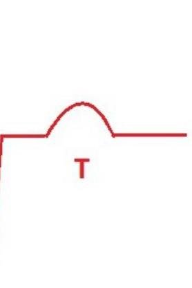 QRS Wave Delta (onda delta)