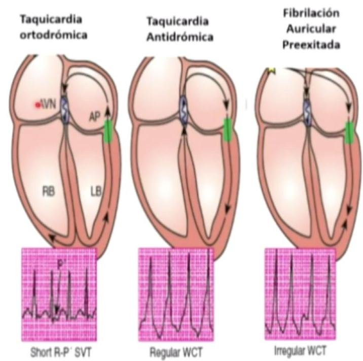 Conducción Normal Representado en un ECG